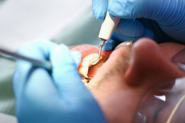 Best Emergency Treatment for Dental Infections or Abscesses in Lake St Louis, MO